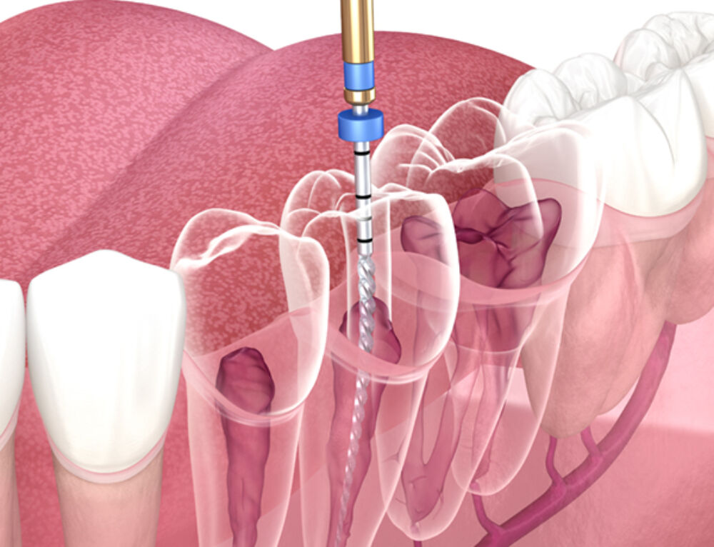 Cost of a Root Canal in Alberta | Chinook Dental Group