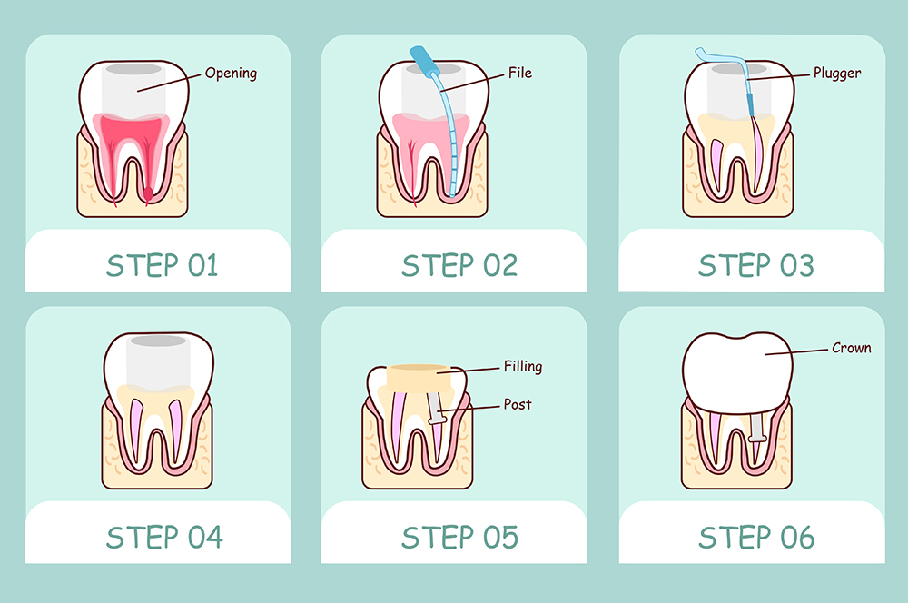 Root Canal Treatment Process