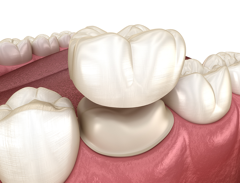 dental crown costs