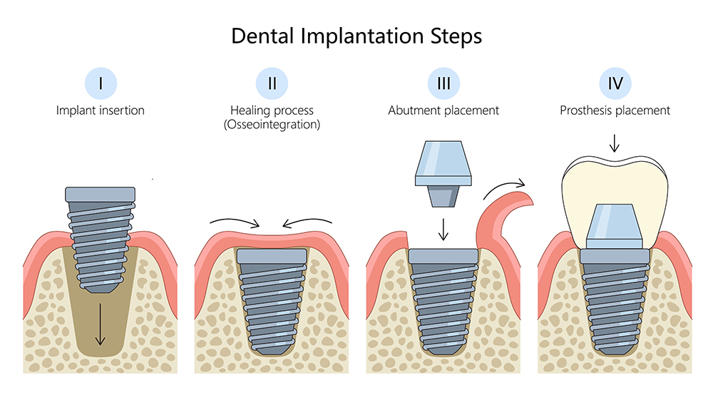 Dental Implantation Process