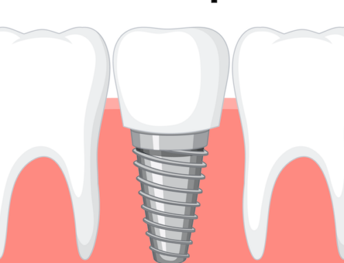 Types of Dental Implants: What Are Your Options?