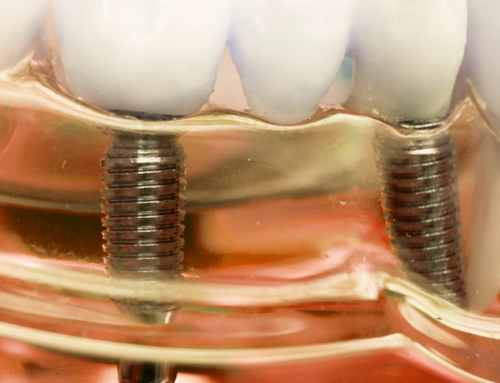 How Long Do Dental Implants Last?