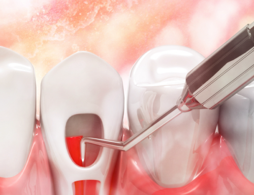 Root Canal Calgary