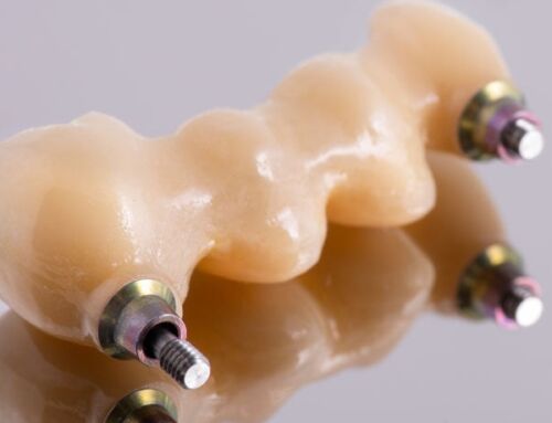 Dental Implants vs Bridges: Which is the Better Choice?