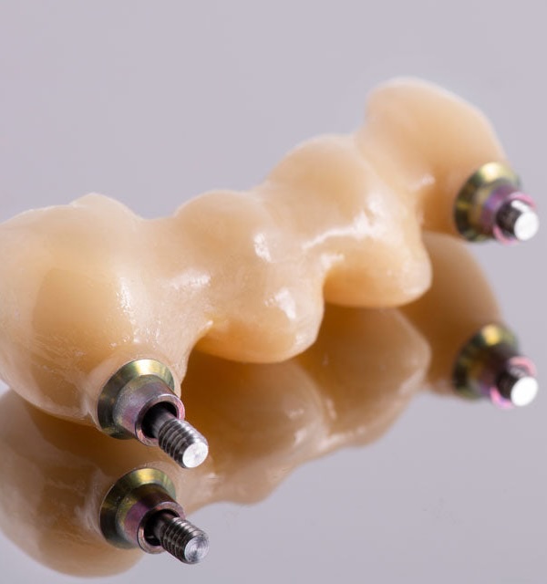 dental implant vs bridges