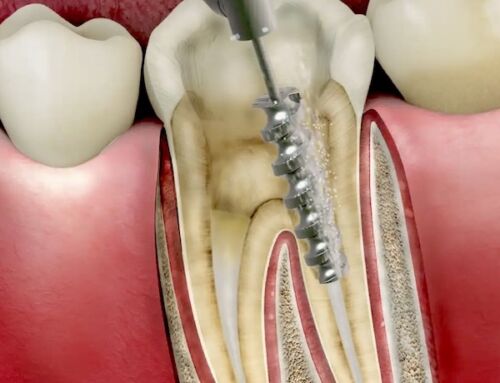 Signs You Need a Root Canal