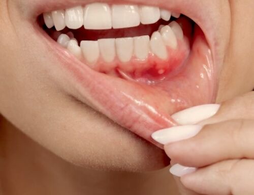 White Spot on Gums: Causes, Symptoms, and Treatment