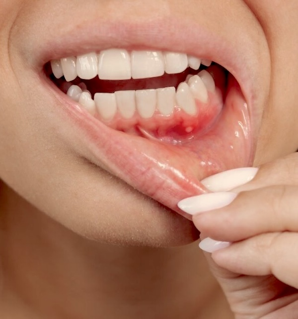 white spot on gums